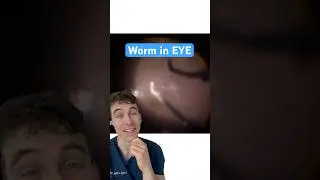 Worm Parasite in Eye - Wild Case