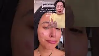 DIY acne hack? #facialtreatment #icecube #icefacial #acne #acnetreatment #acneproneskin #diyideas