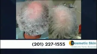 Hair Restoration in New Jersey | Dr. Jeffrey Rapaport 201-227-1555