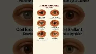 Les types de maladies des yeux#sant&eacute; #shorts
