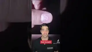 Orthopedic surgeon discusses how fast nails grow and how long it will take for a nail to grow back