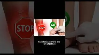 Do NOT Massage Your Leg If It Looks Like This 🛑