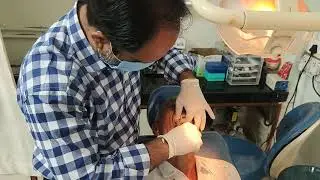 Painless removal of tooth 🦷🦷 ll #extraction #painlesssurgery #molars