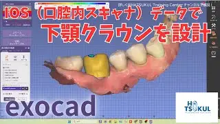 #271　exocad設計　IOS（口腔内スキャナ）データで下顎クラウンを設計！（解説なし版）