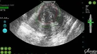 Sonata Procedure - Single Ablation of an Intramural Fibroid