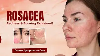 Rosacea,what is rosacea how to manage and what is causes symptoms solution of rosacea.