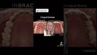 Lingual braces pros and cons #shorts #braces #teeth #orthodontist