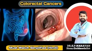 Colorectal Cancer With All Familial Variant Simplified (Hindi)