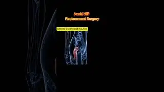 How to Avoid Hip Replacement Naturally?|   !in Hindi | Dr Ajay Randive |#shortsvideo