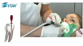 VDW GUTTAFUSION Clinical Use