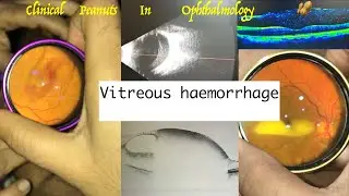 Vitreous haemorrhage// Subhyaloid haemorrhage // Sub RPE haemorrhage :- OCT / B scan / Fundus pictur