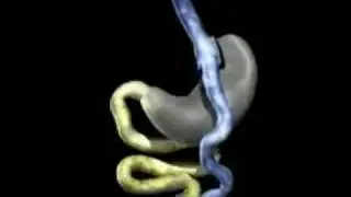 Laparoscopic Roux-en-y Gastric Bypass by Marc Zare, MD