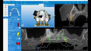 RealGUIDE Software: Implant Planning- Fully Edentulous