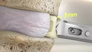 STALIF M&trade; MIDLINE II    Anterior Lumbar Interbody Fusion