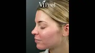 VI Peel Process | What To Expect When You're Peeling!
