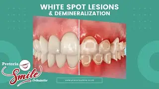 White Spot Lesions & Demineralization