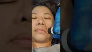 Come with me for my 3rd CO2 laser treatment. Progress in the end.🫶