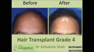 Grade 4 results at Elegance Clinic Surat by Dr. Ashutosh Shah, Cosmetic and hair transplant surgeon