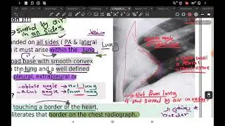 lec 4 interpretation of abnormal chest x ray/ part 1