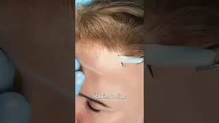 How Scalp Expansion Works 🤔