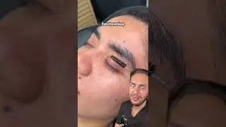Eyebrow hair transplant: longer, fuller brows