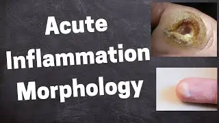 Acute Inflammation Morphology