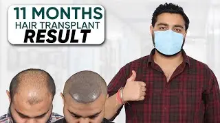 Hair Transplant in Hassan | Best Results & Cost of Hair Transplant in Hassan (dLmeaINqT8)
