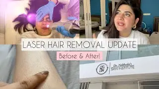 Full Body Laser Hair Removal Update | Does it Make a Difference? GlossipsVlogs