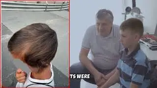 Total Hair Loss in Children & Adults Immunological Treatment & Case Study