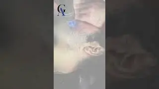 Acne Treatment by Dr Ghazanfer Ali