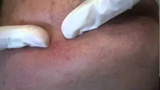 Live Isolaz laser acne treatment!