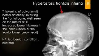 CASE 608 Hyperostosis frontalis interna  HFI