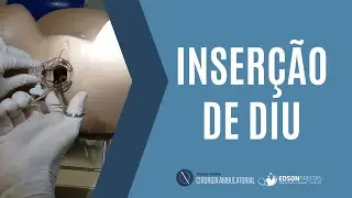 Inser&ccedil;&atilde;o de DIU (Intrauterine device - IUD)
