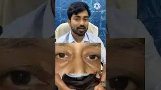 চোখের পাতার উপর হলুদ দাগ মানেই কি তার কোলেস্টেরল হয়েছে?#education #health #cholesterol
