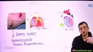 567 Pulseless Electrical Activity | CARDIOLOGY |