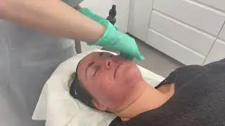 Clinic Case Study -  Dr Ana The Skin Clinic - Integrated RF Microneedling case study