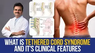 What is Tethered Cord Syndrome and It's Clinical Features | Dr. Ravi Kumar, Neuro Surgeon
