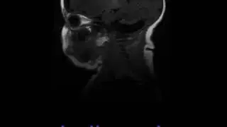 Ataxia telangiectasia