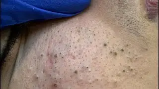 Soko Korean Skincare Routine (Blackhead Removal & Deep Cleansing For Clear Skin)