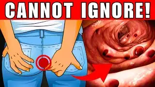 7 Hidden Signs of Bowel Cancer That Could Save Your Life