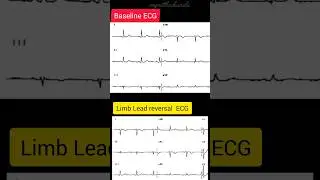 Identify which limb lead has been reversed during ECG recording | ECG series | #ecg