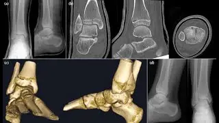 Three dimensional CT reconstruction; raw axial slice‑by‑slice data from a CT scan to 3D