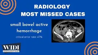 Most Missed Cases: Small Bowel Active Hemorrhage