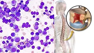 The Struggles of Living With Multiple Myeloma | A Life Update