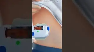 How an Insulin Pump Works in 3D | Diabetes Treatment Animation Explained