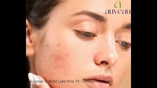 Aviclear in West Lake Hills TX  - Auveau Medspa