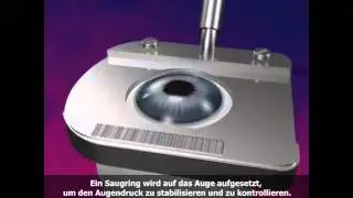 LASIK OP (Animation) - www.augenlaser-tuerkei.de