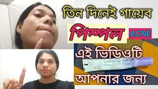 HOW TO DISAPPEAR YOUR ACNE IN 3 DAYS ।। Remove Pimple Only in  Three days।। Skin care routine ।
