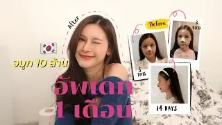 อัพเดทจมูกสิบล้าน! จาก 🇰🇷 ครบ 1 เดือน + เล่าประสบการณ์ช้ำใจ | Memii 🧸🌷