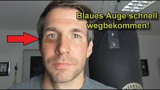 Blaues Auge schnell über Nacht wegbekommen Veilchen Blaues Auge was hilft schnell bei blaue Flecken